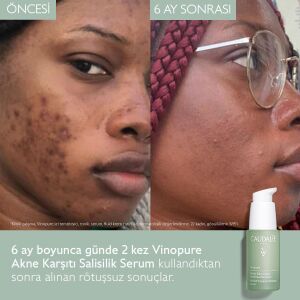 Caudalie Vinopure Akne Karşıtı Salisilik Serum 30 ml - 5